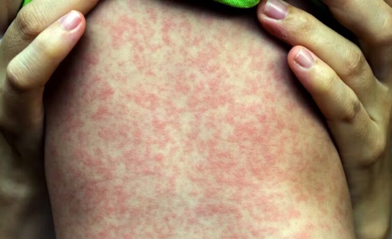 Sarampión se dispara en EUA; primer caso en NYC de virus Chikungunya